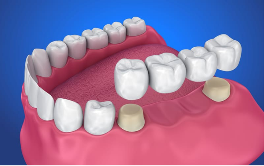 أنواع تركيبات الأسنان الثابتة